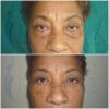 BLEFAROPLASTIA1