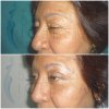 BLEFAROPLASTIA2