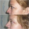 BLEFAROPLASTIA3