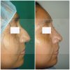 RINOPLASTIA 3