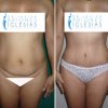 ABDOMINOPLASTIA